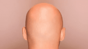 baldness