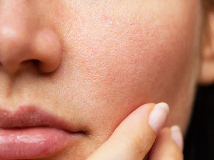 home remedies for open pores in tamil
